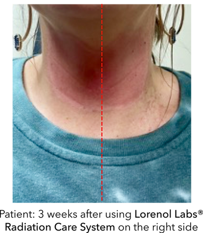 post radiation results