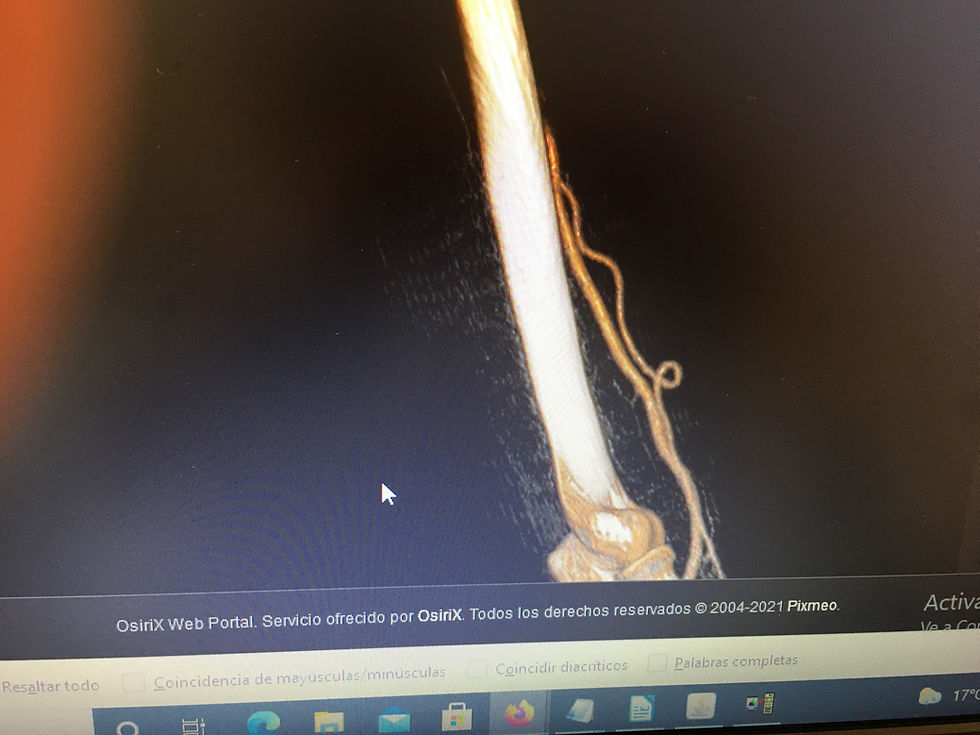 Aneurisma Arteria Braquial accesoria colateral interna Inferior Tratada quirúrgicamente