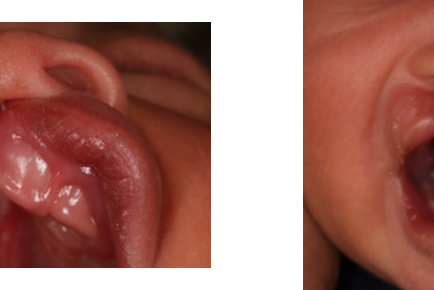 right unilateral complete cleft lip and palate