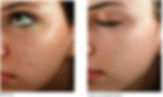 Akneärr, Microneedling Dermapen utbildning