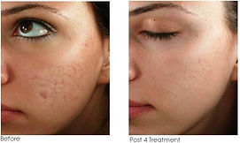 Akneärr, Microneedling Dermapen utbildning