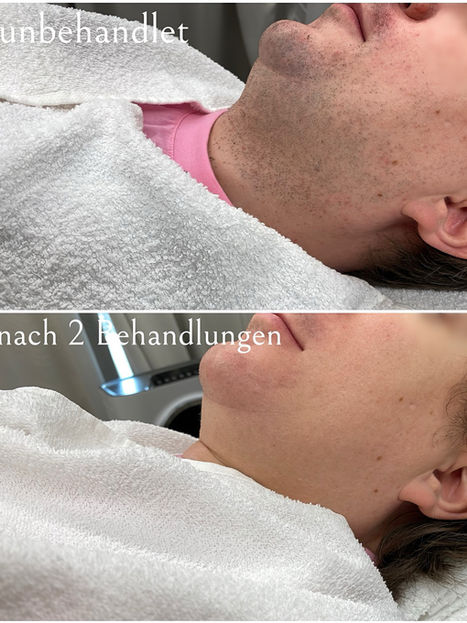 Vorher-Nachher-Ergebnis nach 2 Laserbehandlungen am Kinn mit deutlich reduzierten Haaren