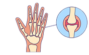 arthrities.png