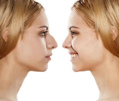 Rhinoplasty or nose surgery is among the most sought after cosmetic surgery and is sometimes referred to as “nose re-shaping” or a “nose job,”