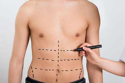Abdominal etching is a body contouring plastic surgery procedure that works to remove excess fat from between the abdominal muscles.