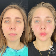 Facial Balancing St. Pete