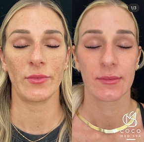 Cosmelan Peel St. Pete Front