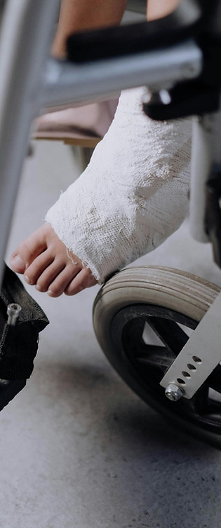 תמונה להמחשה רגל מגובסת