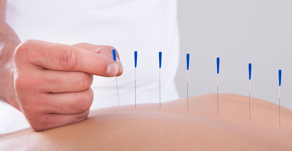 Acumpuncture-2.jpg