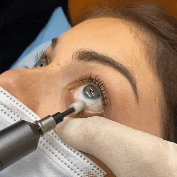 Blephex procedure gif.gif