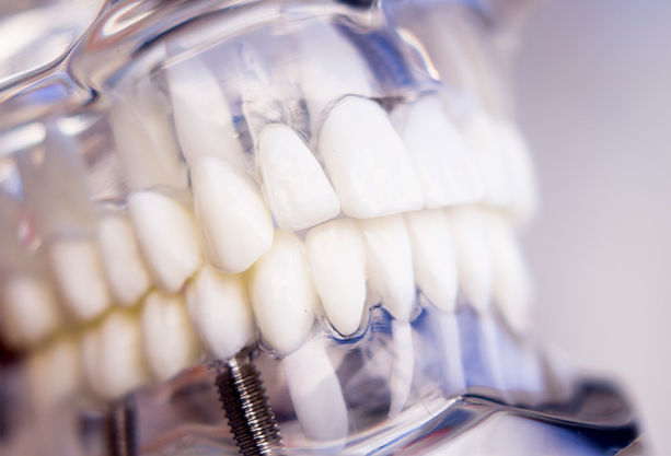 implantes-dentales-global-dent-3.jpg