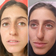 טיפול בפיגמנטציה בעזרת קרם הבהרה וטיקסל