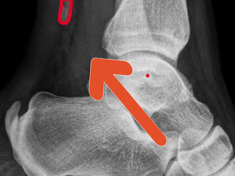 What is An Achilles Tendon Avulsion?