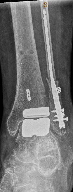 Total ankle replacement surgery Newcastle Lake Macquarie Central Coast