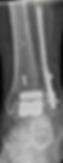 Total ankle replacement surgery Newcastle Lake Macquarie Central Coast