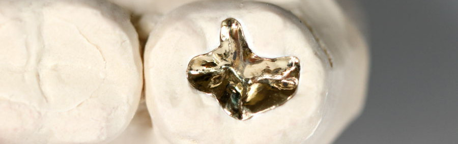 Full Gold Inlay