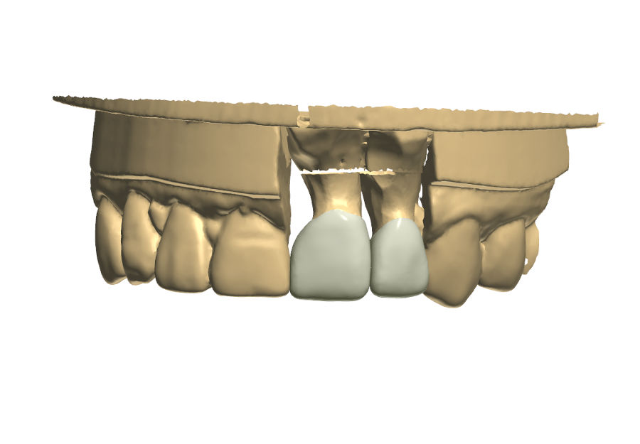Northshore Dental Labs | CAD/CAM