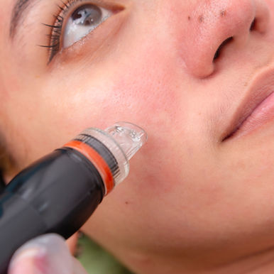 Example of Vacuum Suction Facial Treatment Deep pore cleaning procedure at an aesthetic cl