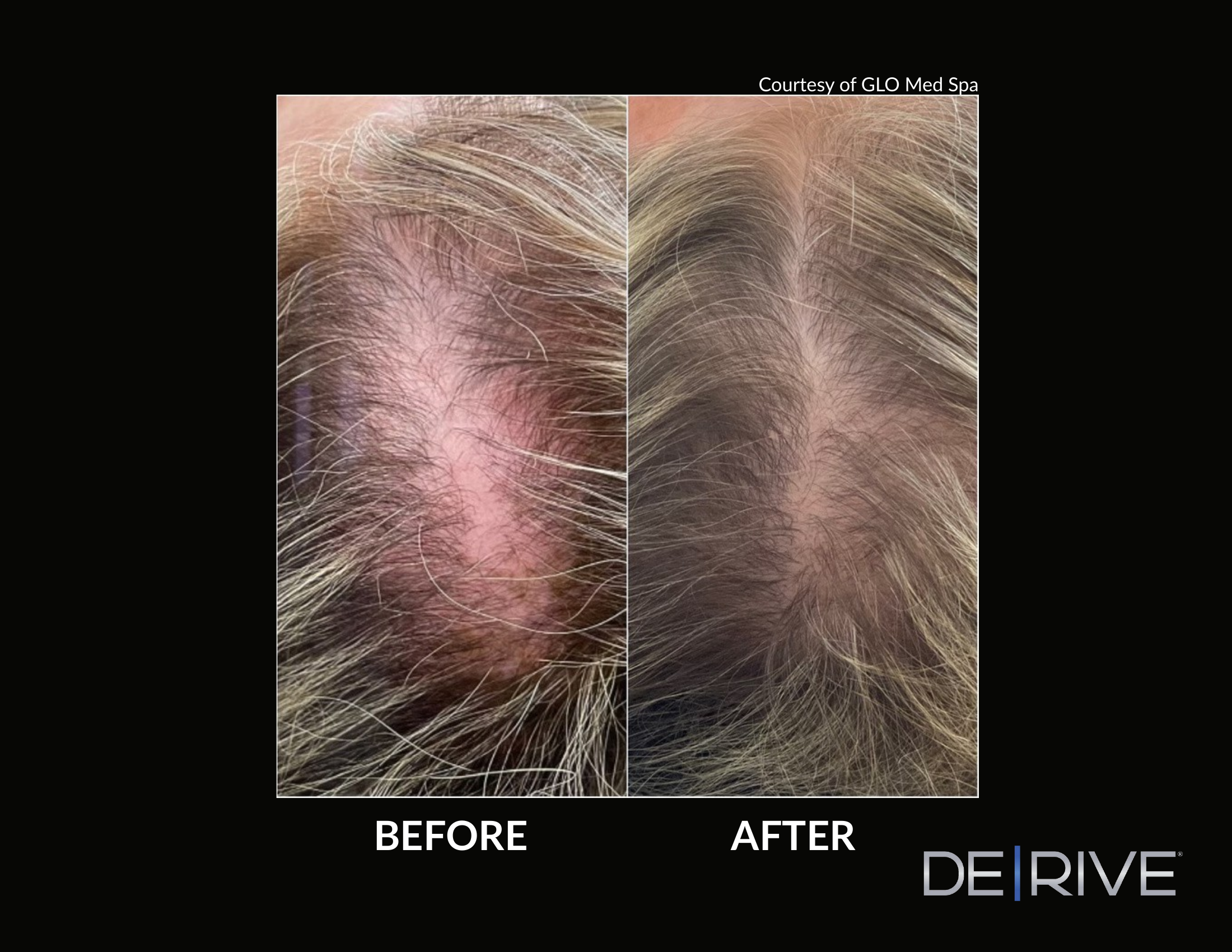 De/Rive Scalp Therapy before and after result