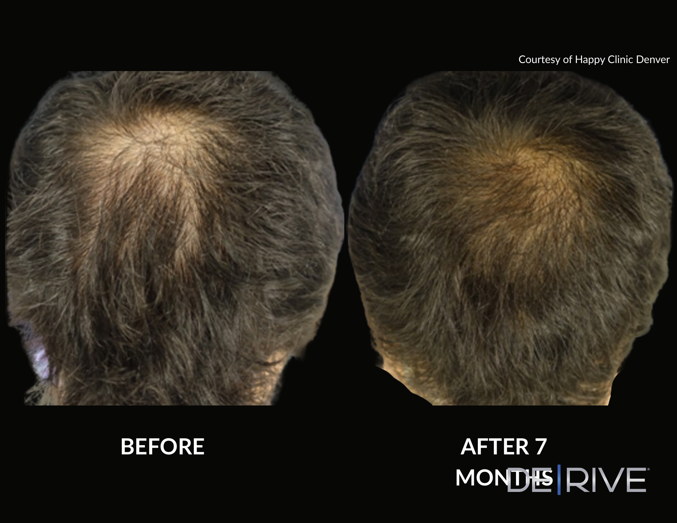 De/Rive Scalp Therapy before and after result