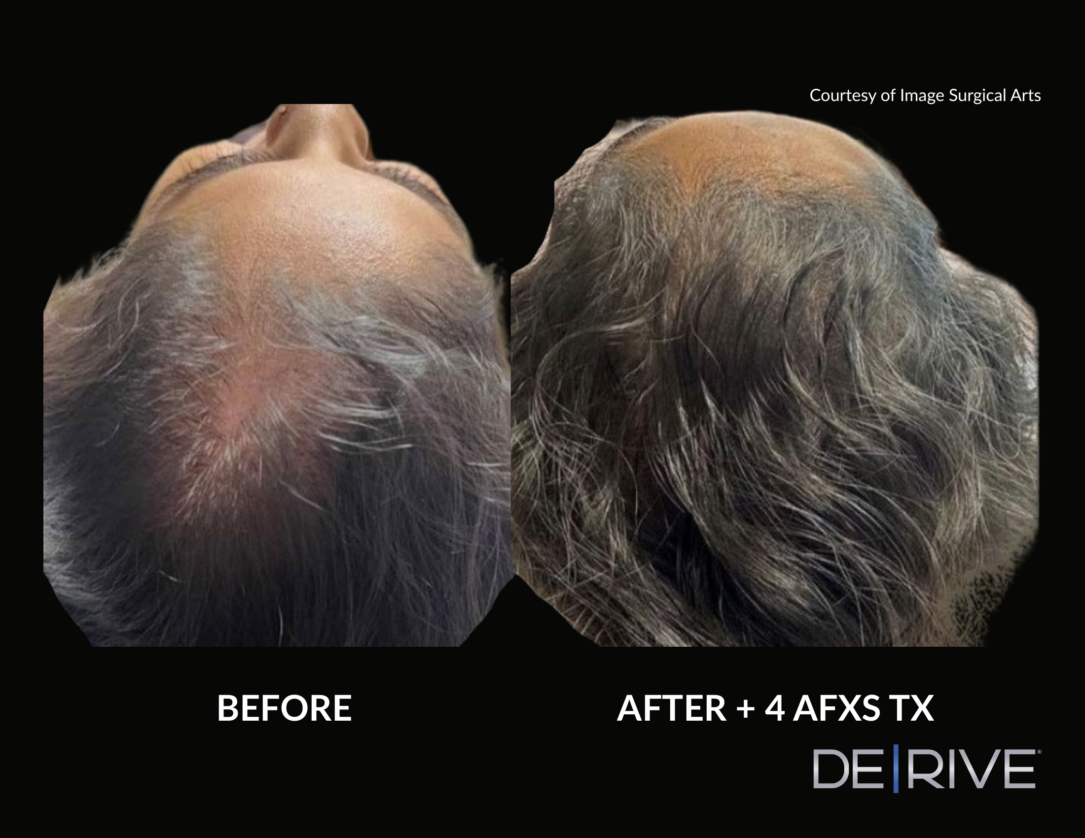 De/Rive Scalp Therapy before and after result