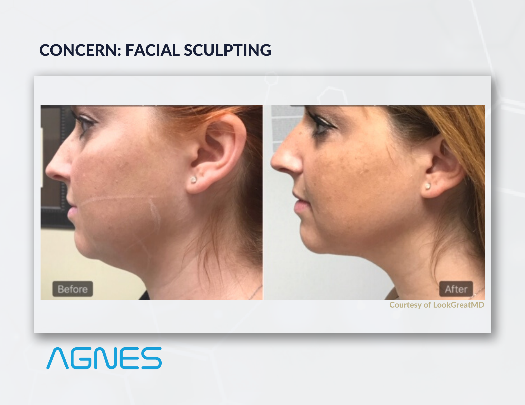 Agnes RF before and after result, facial sculpting