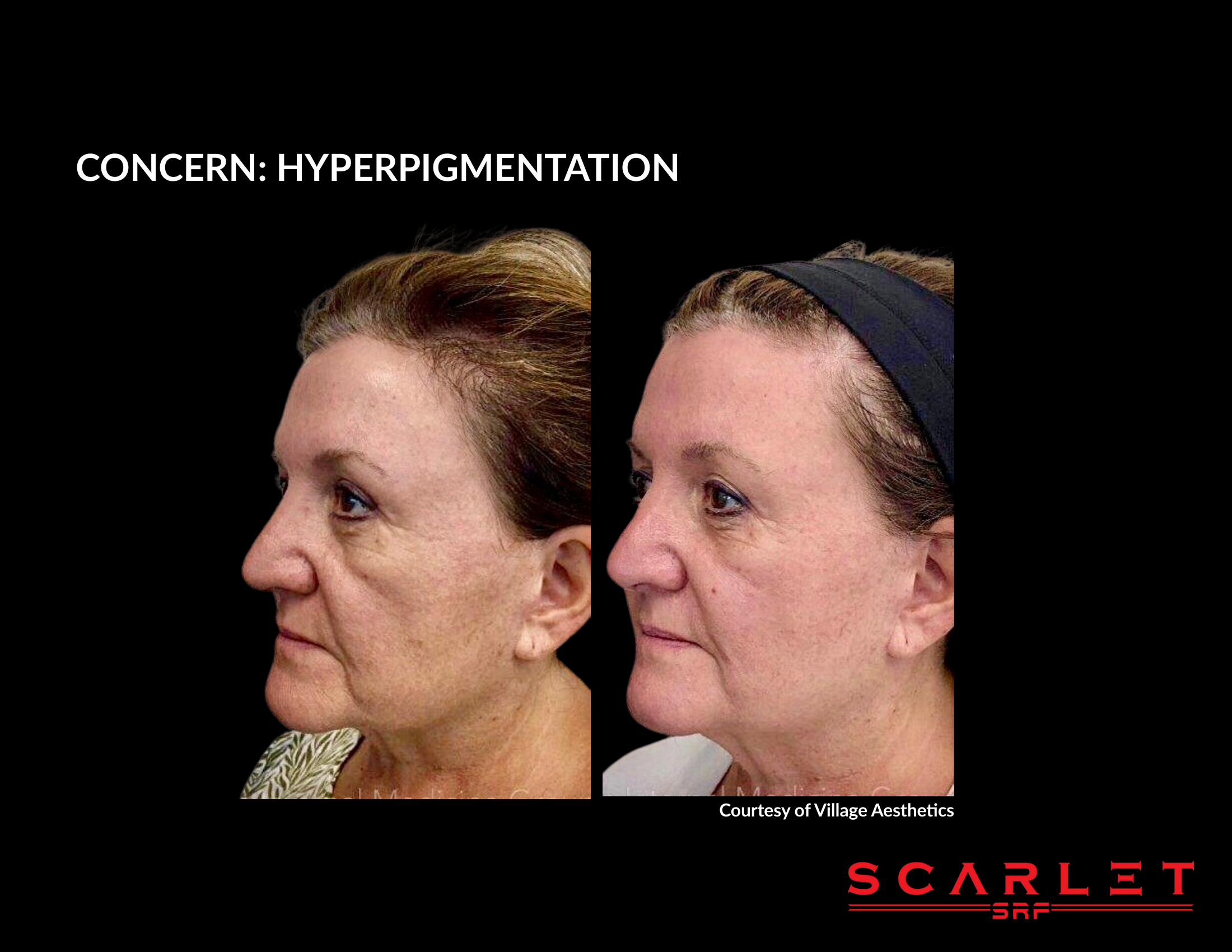 Scarlet SRF before and after result, hyperpigmentation