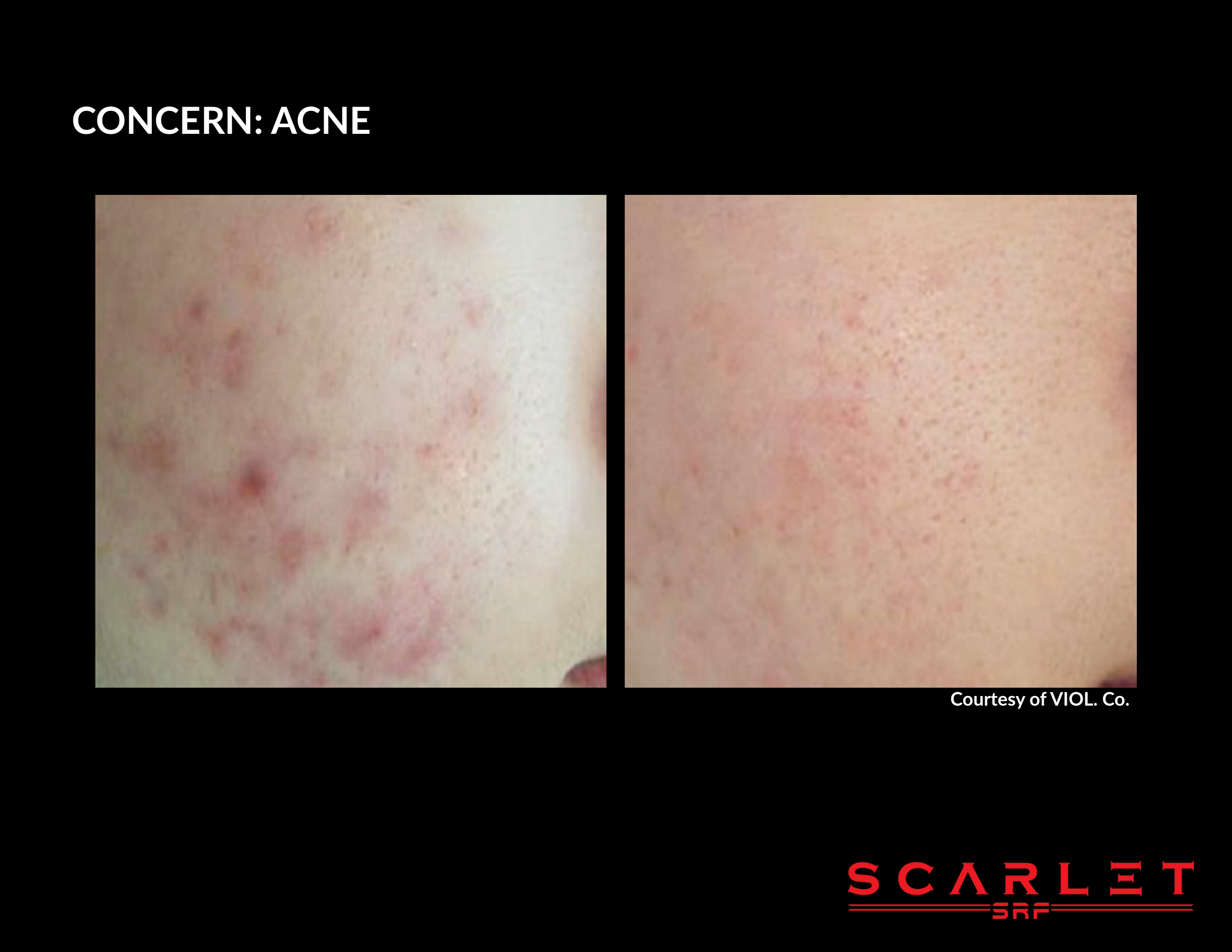 Scarlet SRF before and after result, acne