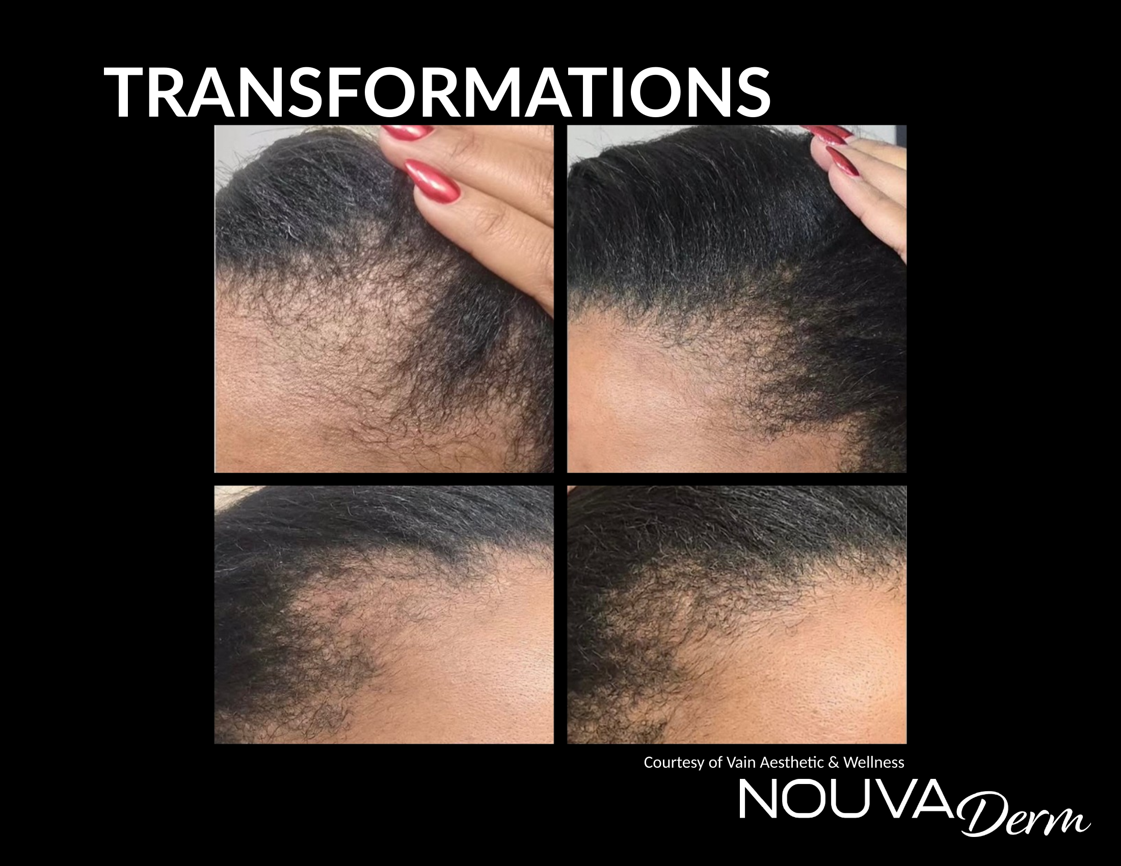 NOUVADerm before and after result
