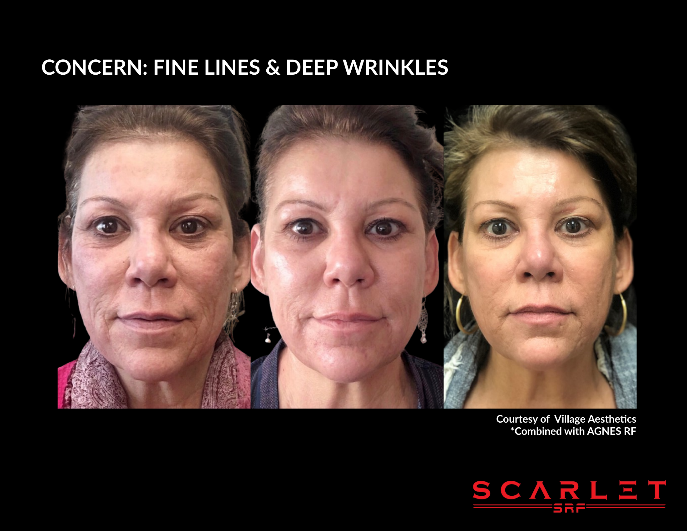 Scarlet SRF before and after result, fine lines & deep wrinkles