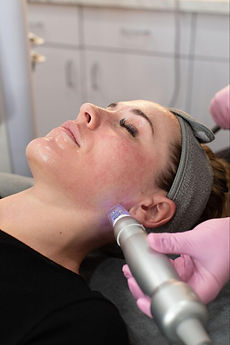 Scarlet SRF microneedling treatment, Herrington Aesthetics in Huntsville, AL