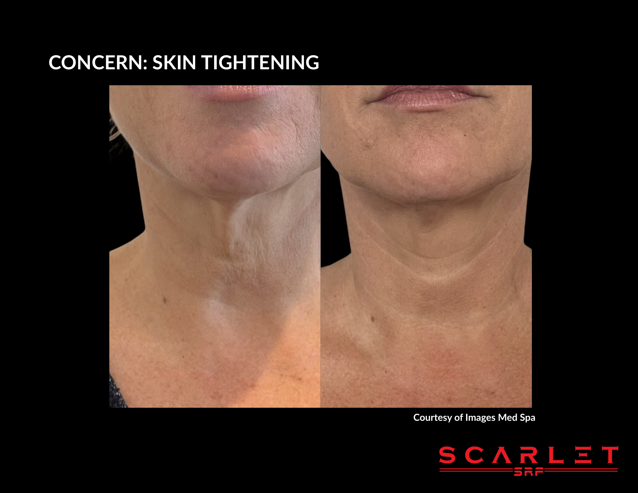 Scarlet SRF before and after result, skin tightening
