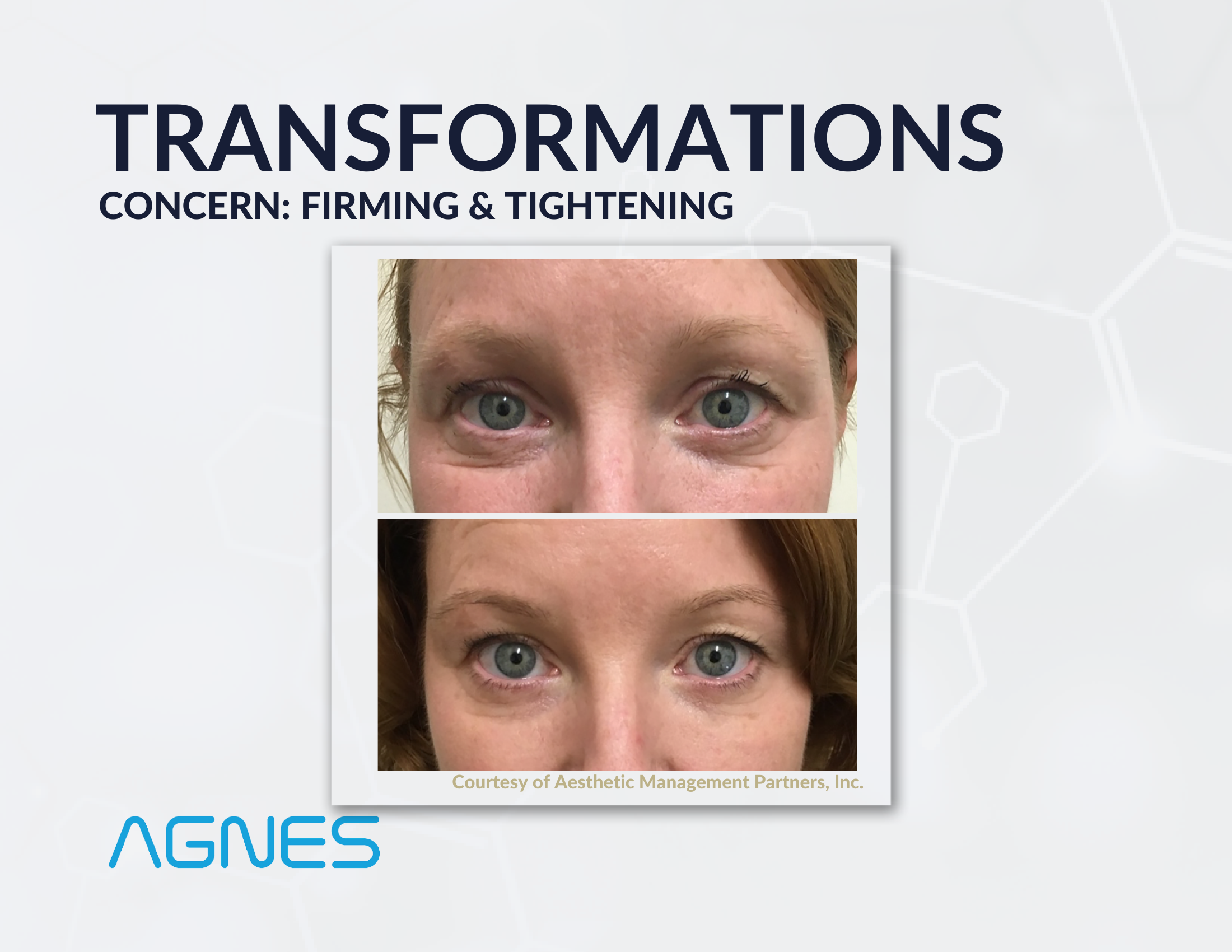 Agnes RF before and after result, firming & tightening