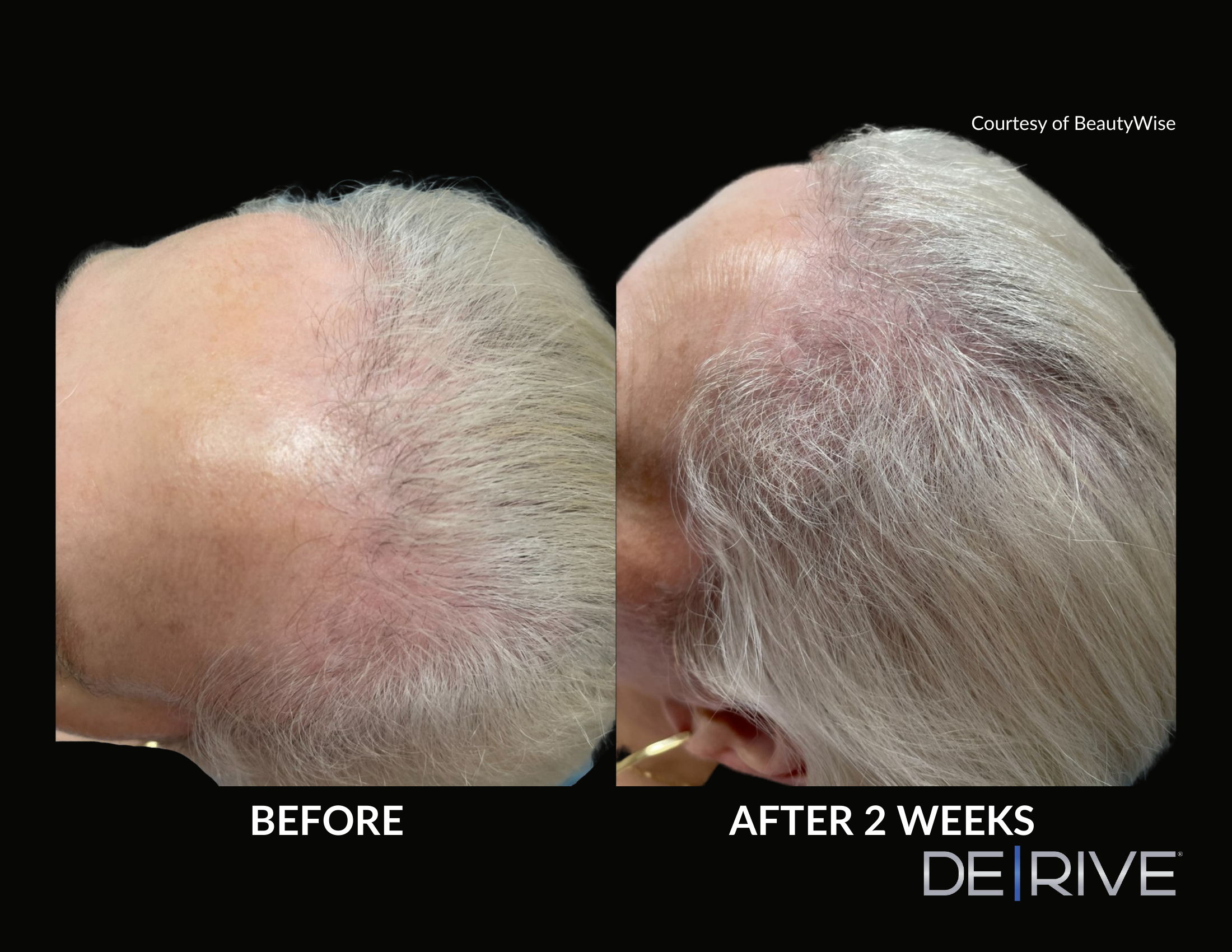 De/Rive Scalp Therapy before and after result