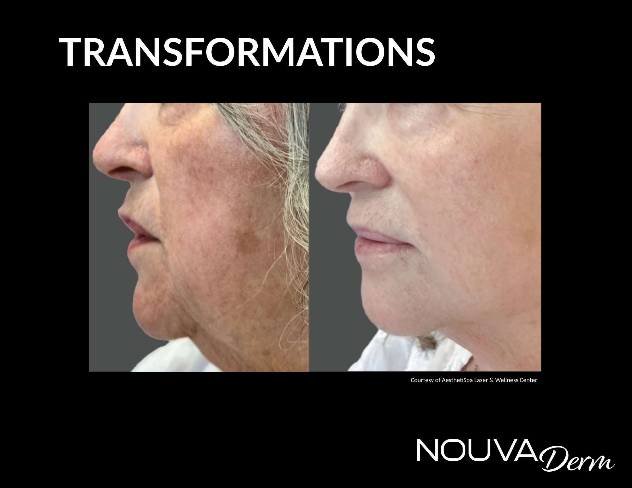 NOUVADerm before and after result