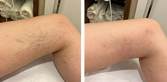 imagem de procedimento secagem de vasinhos