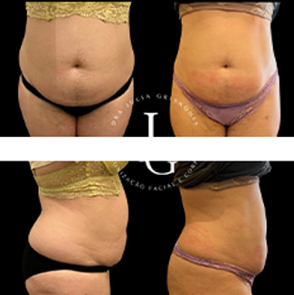 imagem de procedimento de lipo enzimática