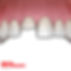 BROKEN-TOOTH-Dental-Emergencies-Emergency-Dentist-in-Hamilton-ON-Spinel-Dental.jpg