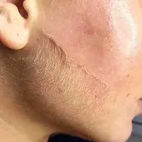 dermaplaning-peach-fuzz-off-face.webp