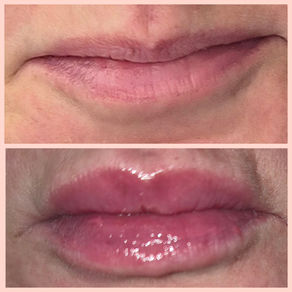 The Truth About Lip Fillers: What to Expect from a Natural Result in Kingsbridge