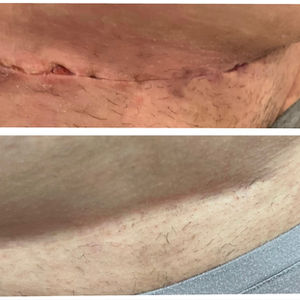 Blizny po cesarskim cięciu