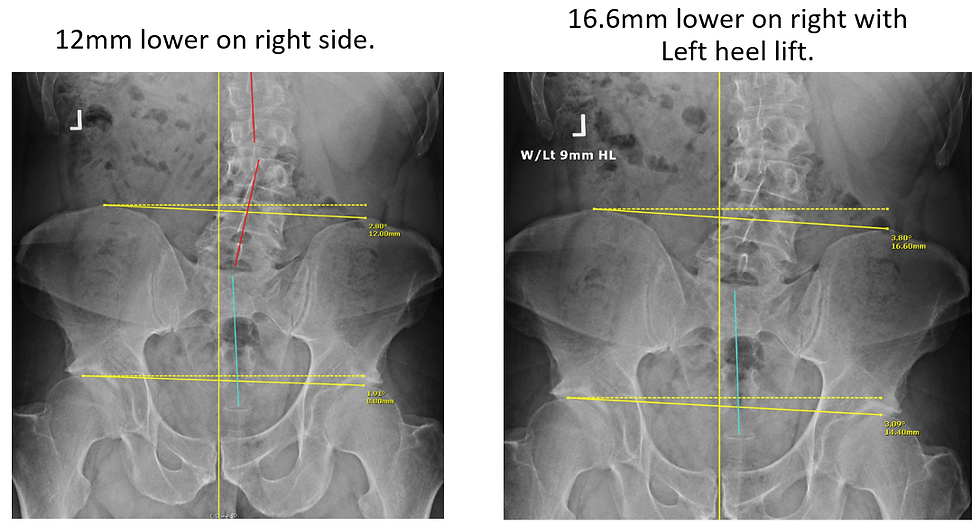 X-ray showing pelvic tilt corrected with a heel lift intervention