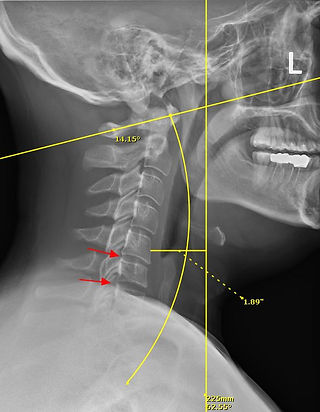 Evaluating a lateral cervical spine x-ray with owl chiropractic, lancaster pa