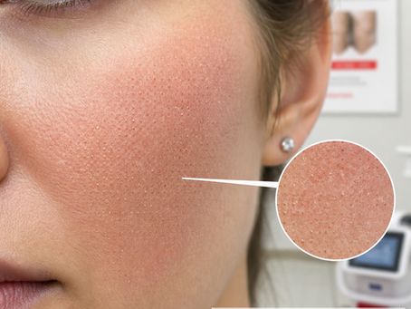 Best Laser Treatments for Age Spots