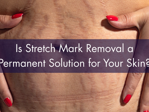 Is Stretch Mark Removal a Permanent Solution for Your Skin?