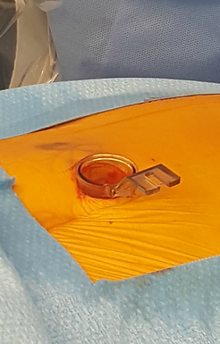 An endoscopic tube for minimally invasive spine surgery minimizes muscle damage and post-operative pain | Dr. Benjamin Bjerke