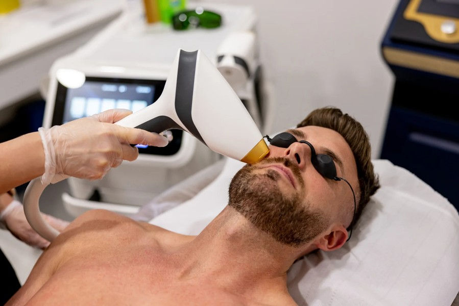 Men's Beard Laser Hair Removal