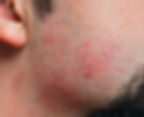 shaving can cause razor burn