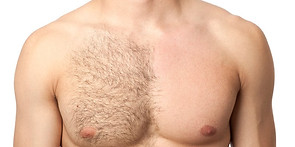 Chest Laser Hair Removal