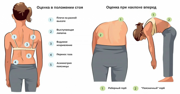 лечение сколиоза в Таллинне